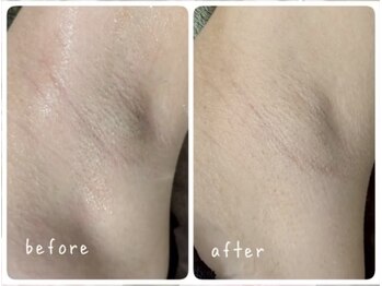 ホッコリ 府中店(HOKKORI)/【男女OK！】痛みの少ない脱毛