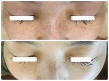 ルミエール フォレストサイド(L’MIERE forestside)/シミはケアでここまで変化します