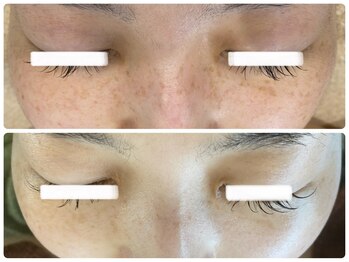 ルミエール フォレストサイド(L’MIERE forestside)/シミはケアでここまで変化します