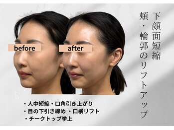 アールメディカルサロン 富山院(R Medical Salon)/リフトアップ