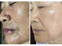 ビューティーガーデン(Beauty Garden)の雰囲気（レーザーでも満足できなかったシミケア！若返る秘訣満載）