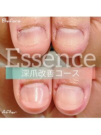 深爪矯正-3回コース