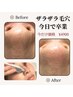 【限定価格】詰まり毛穴ごっそり除去！ハイドラ毛穴洗浄 (全顔）¥8900→¥4900