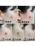 1箇所5mmまでのシミ◎シミ改善！シミ緩和！ターンオーバー改善◎当日予約不可