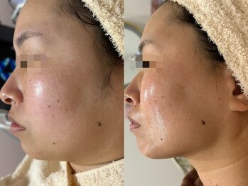 エミュ(emu)/レモンボトルとエステ継続例