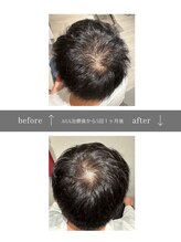 青空 天神大名店(SORA)/マイクロチップ頭皮 &nbsp;5回