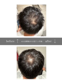 青空 天神大名店(SORA)/マイクロチップ頭皮 &nbsp;5回