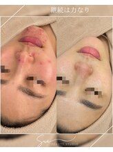 スア ビューティースタジオ(Sua BEAUTYSTUDIO)/本気の肌質改善　