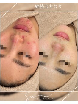 スア ビューティースタジオ(Sua BEAUTYSTUDIO)/本気の肌質改善