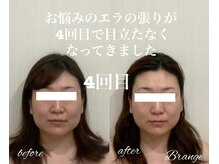 パラフューズ 札幌店 ブランジュ(PARAFUSE.)の雰囲気（＼結果出しはお任せ／小顔・たるみ・頭の大きさ・エラ張りに！）