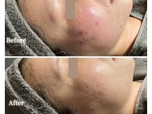 シュシュ(Chou chou)/【Before★After】ニキビ改善