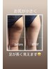 【スキニーデニムが似合う脚になる】美尻美脚を叶える下半身痩身120分¥15400
