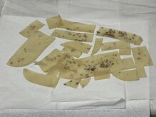 ウルト アルティメイトスキン(ULT ultimate skin)/ホワイトラボで取れたシミ