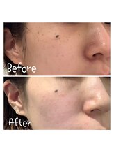 サロンドビオ(Salon de vio)/シミケア