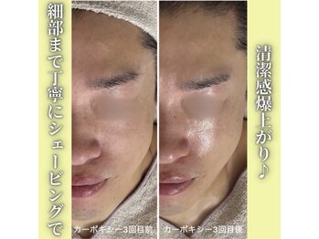 ハニエル(Haniel)/カーボキシー症例