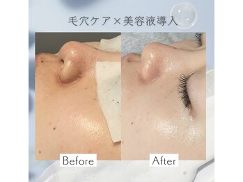 リアン(Lien)/【症例】毛穴洗浄×美容液導入