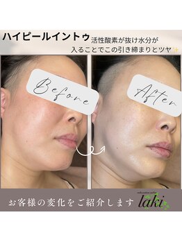 リラクゼーションサロン ラキ(laki)/ハイピールイントゥー