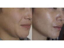 トラット エステアンドアイズ(tratto)/40代　お客様症例写真