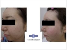 フェイシャルスタイリストサロン 四谷店/ケア例（33）