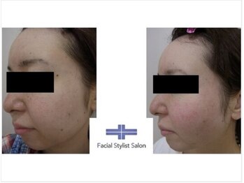 フェイシャルスタイリストサロン 四谷店/ケア例(33)