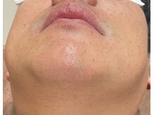 アスティ(Asti)/ひげ脱毛