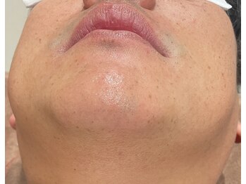 アスティ(Asti)/ひげ脱毛