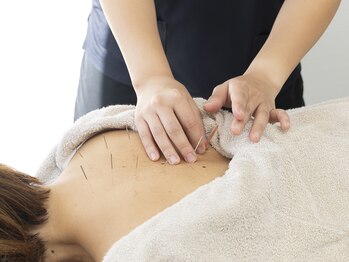 ビーマスター(B-Master)/【慢性的な肩こり、腰痛】鍼灸