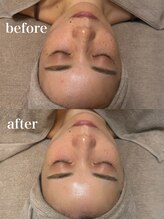 ウンスイスパ(UNSUI SPA)/ララピールビフォーアフター