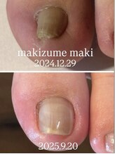 ネイルカフェ ナナ(nailcafe'nana)/巻き爪