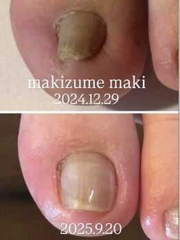 ネイルカフェ ナナ(nailcafe'nana)/巻き爪