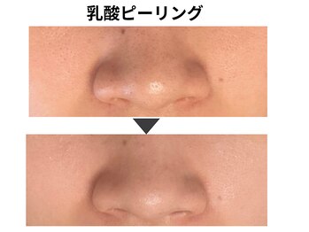 ラディアント たまプラーザ/《乳酸ピーリング》