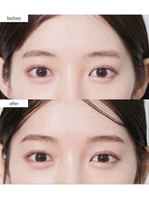 ラキ(LAKI)/HBL ビフォーアフター