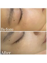 アルメ(arme)/【くすみ特化コース】