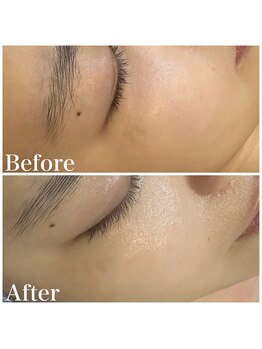 アルメ(arme)/【くすみ特化コース】