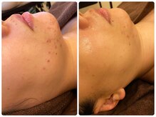 サロンドボーテ サラ(salon de beaute SALA)/陶肌トリートメント