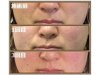 オワゾーブルー(Oiseaubleu)/30代女性・3回施術 before after
