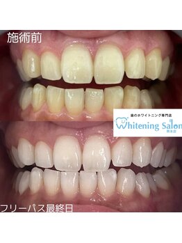 ホワイトニングサロン 熊本店/新市街セルフホワイトニング
