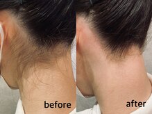 ネイルアンドアイラッシュ アヴィ(Nail and Eyelash A'vi)/ うなじ襟足　光×ワックス脱毛