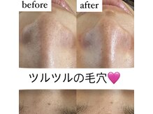 ブルーシー(BLUESEA)/毛穴洗浄＋ハーブピーリング