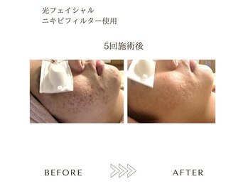 サロン エイトミー(salon 83)/光フェイシャル/before→after