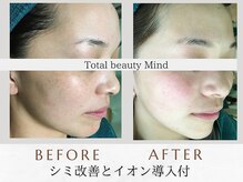 トータルビューティー マインド(Total Beauty)/シミ改善とイオン導入付き