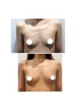 美人バスト 表参道店/【バストアップ/育乳 症例】☆