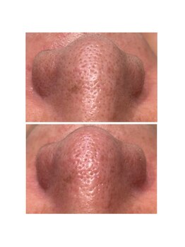 ディシェーレ アスト/ハイドロフェイシャル