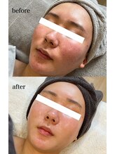 ルラシェ(Relacher)/温石×ハーブ×ポレーション導入