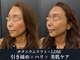 イロハ(IROHA)の写真/兵庫県初導入◆真皮層へアプローチ*高密度エネルギー[チタニウムリフト]で引締め×ハリ×美肌ケアを一度に