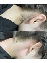 エレナビューティー(Elena Beauty)/うなじW脱毛