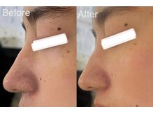 マスカレード 品川(Masquerade)/クリスティーナハーブピーリング