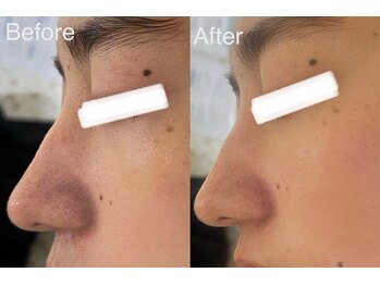 マスカレード 品川(Masquerade)/クリスティーナハーブピーリング