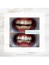 ホワイトニングサロン 名古屋駅店/【ホワイトニング施術例】