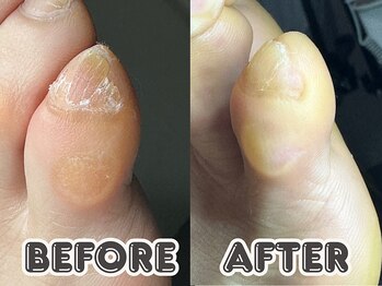 ポドロ ウィズ ニコルル 大阪天満店(PoDoLo with Nicolulu)/【小指の副爪】フットケア大阪